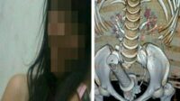 Dokter di Hebohkan Dengan Penemuan Stang Motor di Kelamin Wanita