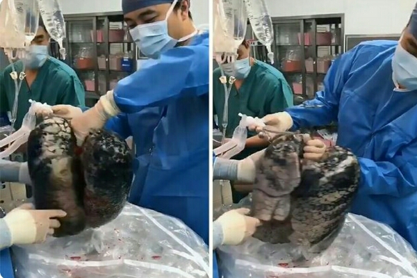 Video Viral: Paru-paru Perokok Sumbangkan Bagian Tubuhnya Saat Meninggal